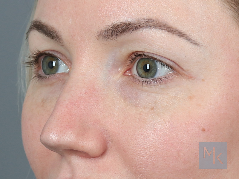 Upper Blepharoplasty Before and After | Dr. Michael Kim