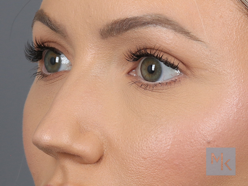 Upper Blepharoplasty Before and After | Dr. Michael Kim