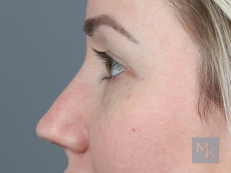 Upper Blepharoplasty Before and After | Dr. Michael Kim