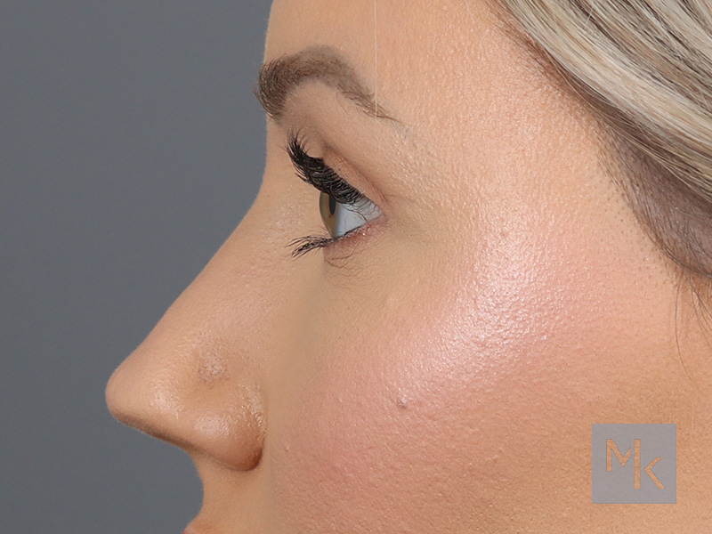 Upper Blepharoplasty Before and After | Dr. Michael Kim