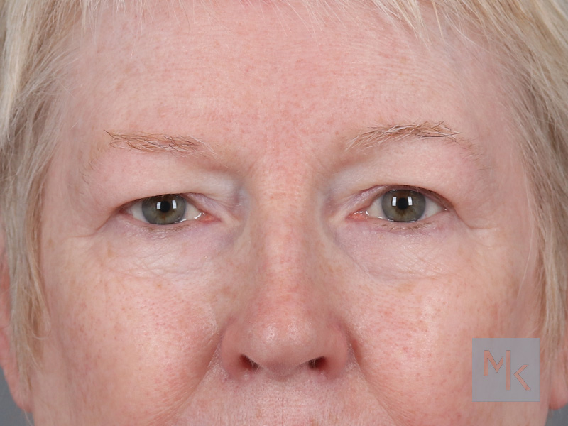 Upper Blepharoplasty Before and After | Dr. Michael Kim