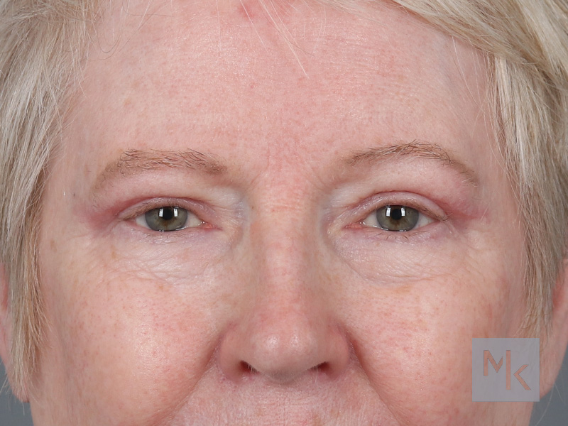 Upper Blepharoplasty Before and After | Dr. Michael Kim