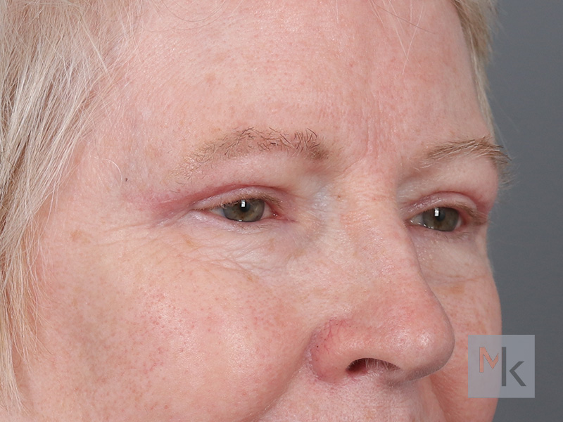 Upper Blepharoplasty Before and After | Dr. Michael Kim