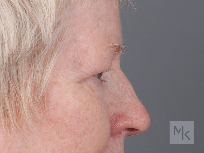 Upper Blepharoplasty Before and After | Dr. Michael Kim