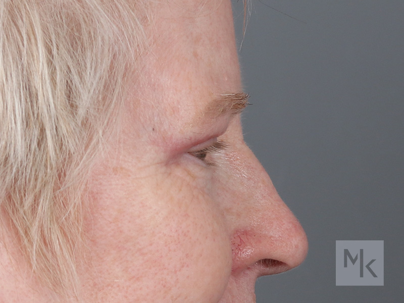 Upper Blepharoplasty Before and After | Dr. Michael Kim