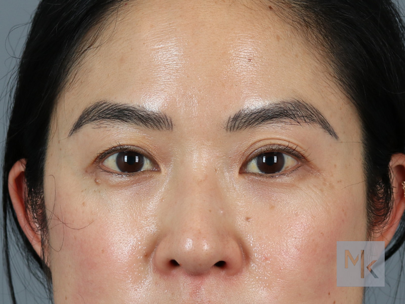 Upper Blepharoplasty Before and After | Dr. Michael Kim