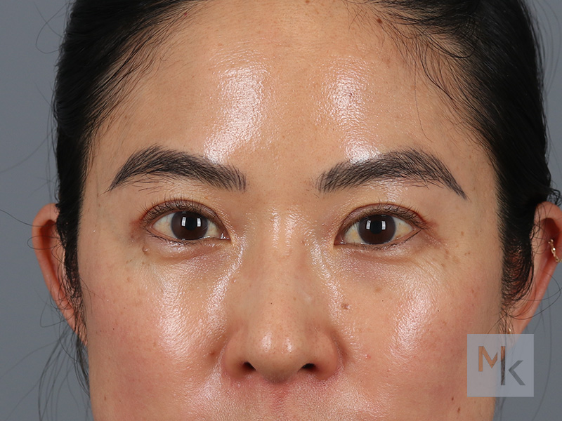 Upper Blepharoplasty Before and After | Dr. Michael Kim