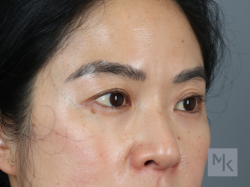 Upper Blepharoplasty Before and After | Dr. Michael Kim
