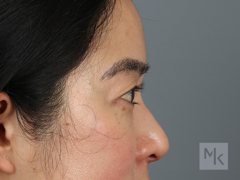 Upper Blepharoplasty Before and After | Dr. Michael Kim