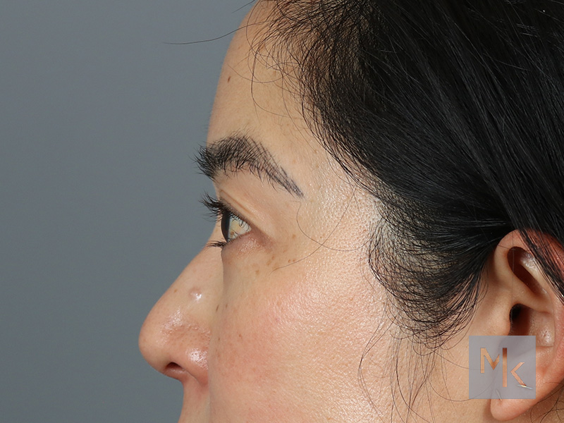 Upper Blepharoplasty Before and After | Dr. Michael Kim
