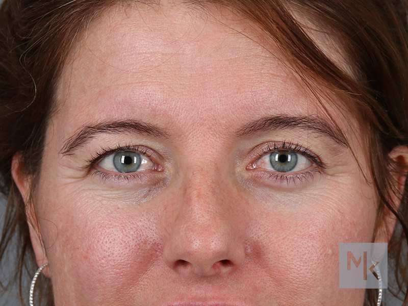 Upper Blepharoplasty Before and After | Dr. Michael Kim