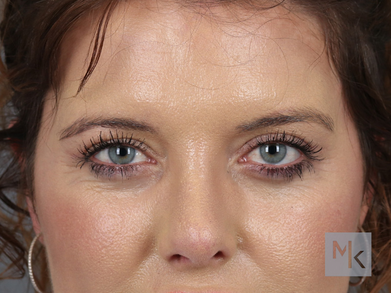 Upper Blepharoplasty Before and After | Dr. Michael Kim