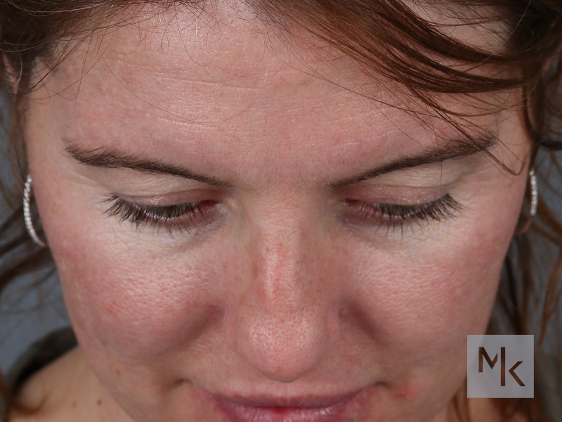 Upper Blepharoplasty Before and After | Dr. Michael Kim