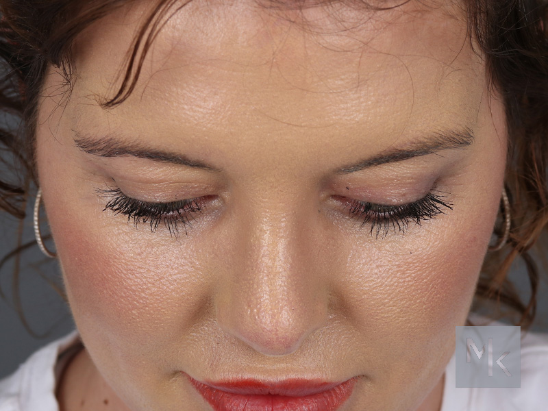 Upper Blepharoplasty Before and After | Dr. Michael Kim