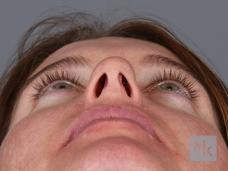 Upper Blepharoplasty Before and After | Dr. Michael Kim