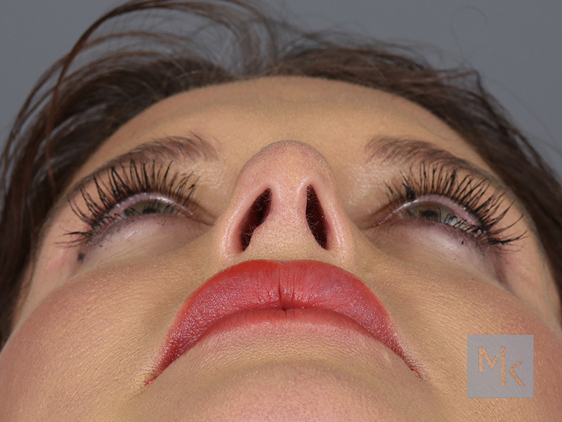 Upper Blepharoplasty Before and After | Dr. Michael Kim