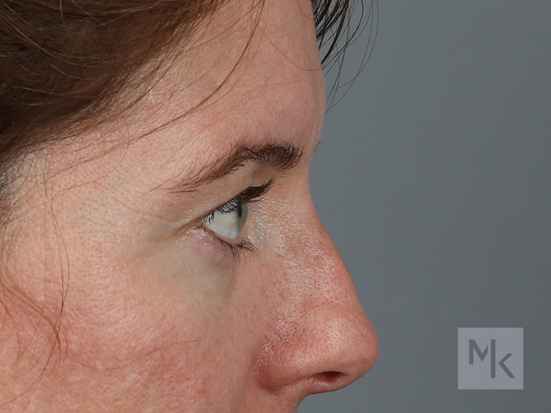 Upper Blepharoplasty Before and After | Dr. Michael Kim